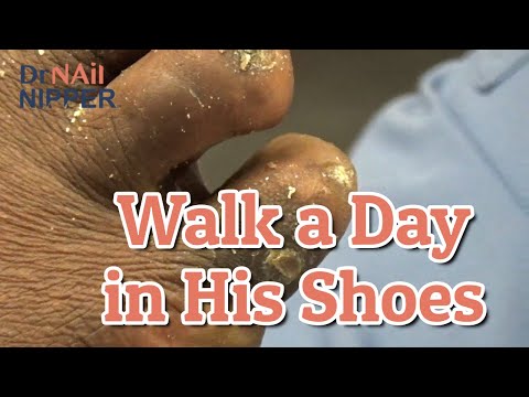 Hard to Walk a Day in His Shoes. Dr Nail Nipper [Callus Tuesday] (2020) 1