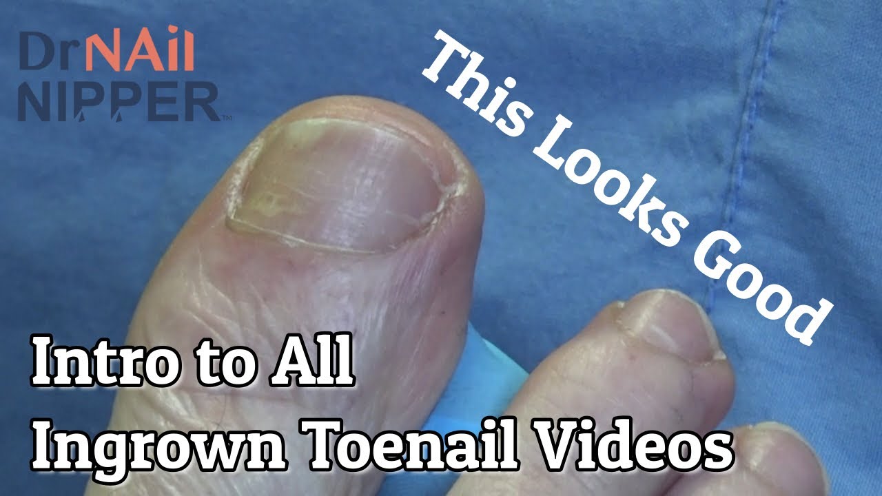 Intro to all Ingrown Toenails Video (2020) - Watch the video for more information 1