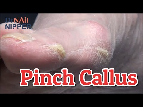That Pinch Callus Looks Awesome and a Surprise [Throwback Thursday] 1