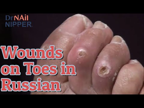Russian Spoken Here? Open Wounds on Toes and Toenails [Throwback Wednesday] 1