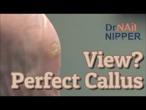 The Perfect Callus View? With a Twist [Throwback Thursday] 1