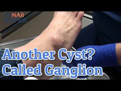 What is a Ganglion Cyst? Is it Cyst week? Dr Nail Nipper [Throwback Wednesday] 1