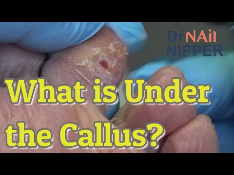 What is under the Callus? [Callus Tuesday] (2020) 1
