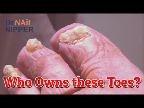 Are your toenails super thick? Dr Nail Nipper Patient [Throwback Wednesday] 1