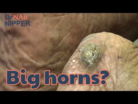 Are you ready for Callus Tuesday? Dr Nail Nipper is Bringing Horns (2020) 1