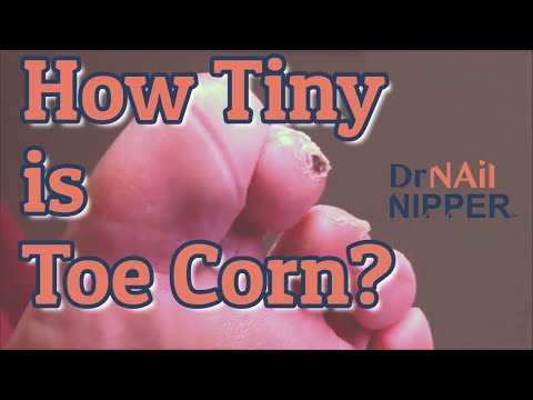 What is a Toe Corn? How small is a Callus? Dr Nail Nipper does Toenails [Throwback Thursday] 1