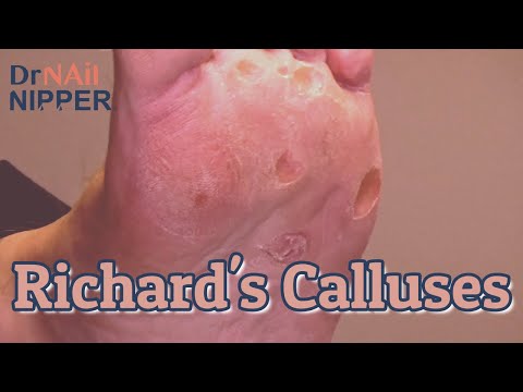 Richard's Calluses [Callus Tuesday] (2020) 1