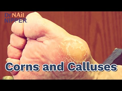Can pressure create Corns and Calluses? Watch until the End, Dr Nail Nipper [Callus Tuesday] (2020) 1
