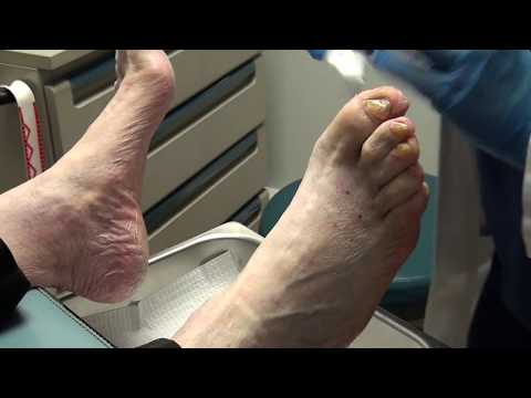 Foot calluses and corns. But Webbed Toes. A True Workup for Dr Nail Nipper. The Doc Part #2 1 Foot calluses and corns. But Webbed Toes. A True Workup for Dr Nail Nipper. The Doc Part #2 1