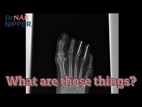 What are foot screws? Take a look with Dr Nail Nipper [Callus Tuesday] (2021) 1