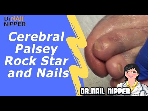 Cerebral Palsy Rock Star Toenails 1