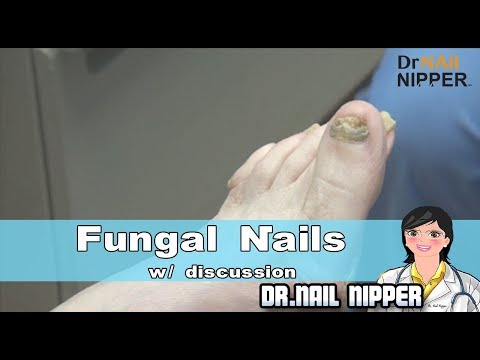 Fungal Nails with a Dr Nail Nipper Discussion 1