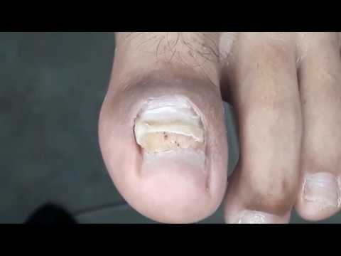 UNHA ENCRAVADA COM COLOCAÇÃO DE ÓRTESE FMM 0,20 By Dr. Nail Nipper. 09/06/20 1