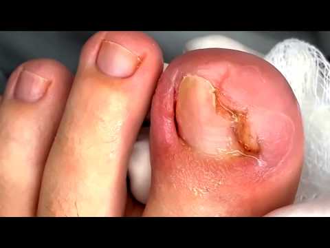 UNHA ENCRAVADA POR CORTE (NAIL ULCER). By Dr. Nail nipper #2 1