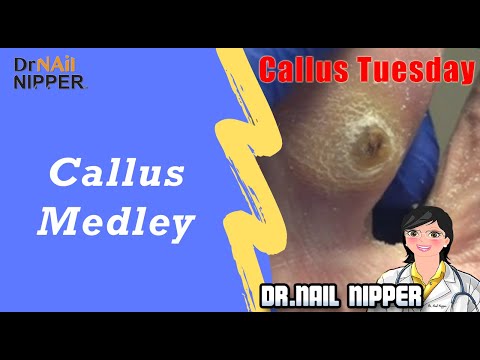 Callus Medley with Music #49 - [Callus Tuesday] (2019) 1