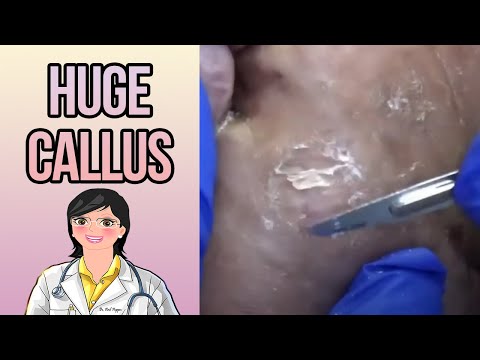 Epic Calluses - with Epic Music 1