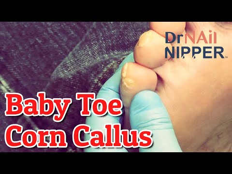 What is Corn Callus? On the Baby Toe? Dr Nail Nipper Explains How Happens[Callus Tuesday] (2021) 1