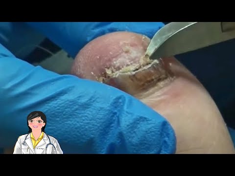Double Fungal Nail Treatment 1