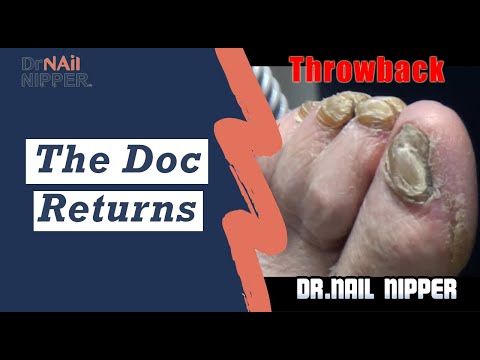 What is onychomycosis? The Doc Returns! Thick Toenails and A Story [Throwback Thursday] 1