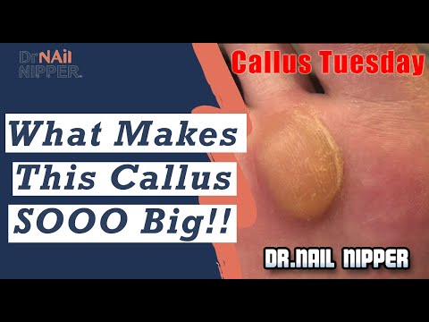 What makes this Callus SOOO Big ?? 1