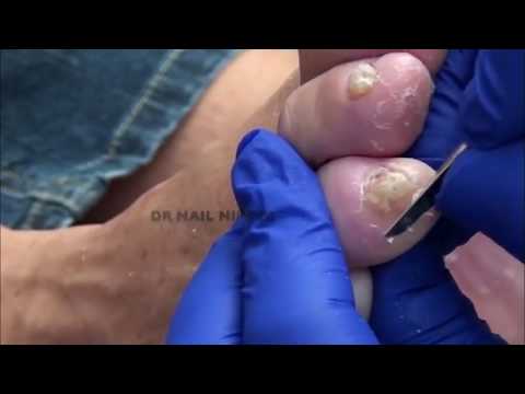 What is a Corn? Dr. Nail Nipper Treats Feet! 1