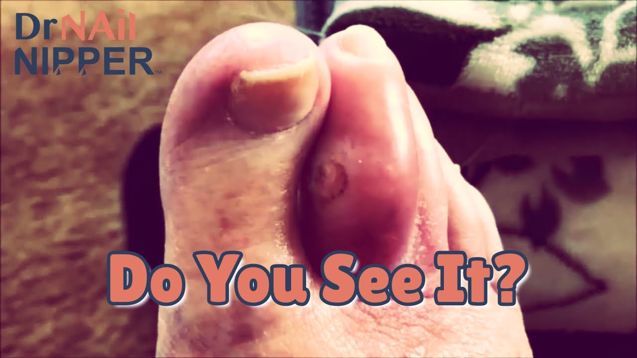 Most Popular Dr Nail Nipper Video. Doing a Pus Pop [Throwback Thursday] 2