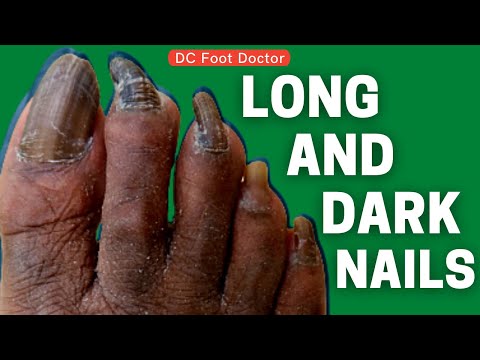 Long and Dark Nails with Streaks: Fungal Infection? Maybe. Maybe Not. (possible fungal toenails) 1