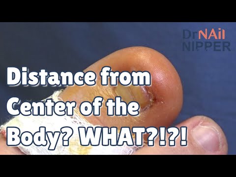 What is a Distal Toenail? Dr Nail Nipper has different type of Nail [Callus Tuesday] (2021) 1