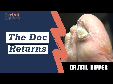No Painful Toenails, Not Removing Toenails - The Doc returns 1 No Painful Toenails, Not Removing Toenails - The Doc returns 1