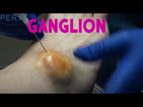 Dr Nail Nipper Removes Ganglion Cyst! 1
