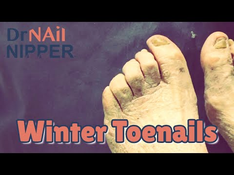 Joanne and Dr Nail Nipper on Feature Friday. Are thick toenails painful? (2021) 1