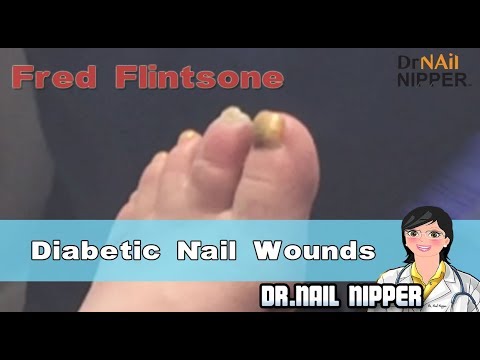 Fred Flintstone - Trimming Diabetic Nails, Neuropathy, and Wounds (2018) 1
