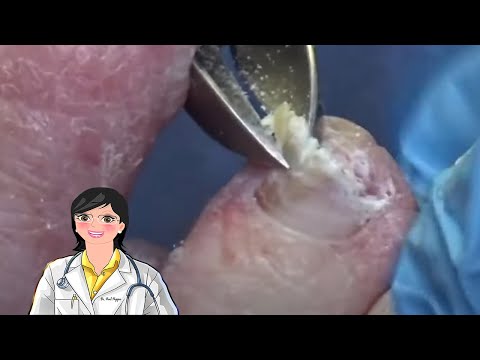 Husband and Wife Fungal Nail Double Feature 1