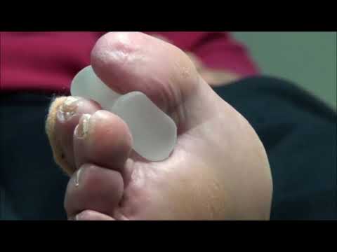 Callus and Padding with Dr Nail Nipper 2018 1