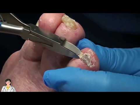 Xtreme Foot Fungus! Welcome Dr. Nail Nipper to the channel! 1 Xtreme Foot Fungus! Welcome Dr. Nail Nipper to the channel! 1