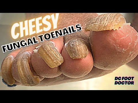 Cheesy Fungal Toenails: Trimming long toenails 1