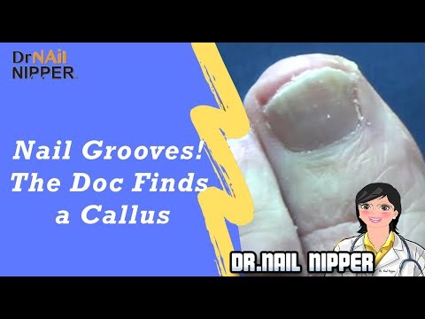 Nail Grooves! Dr Nail Nipper Finds a Callus (2019) 1