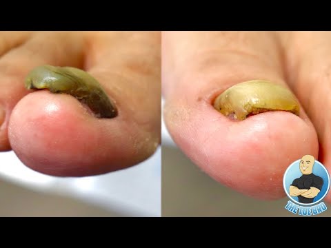 SUPER THICK TOENAIL TRIMMING AND FILING ***TOENAIL FUNGUS OR DAMAGED NAILS???*** 1