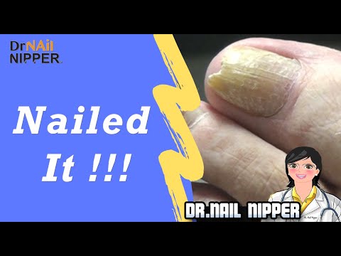 How to Treat Diabetic Toenails? Talking Diabetic Nails in Nailed It !!! (2019) 1