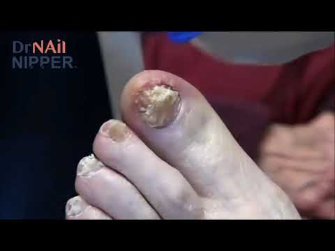 Large Nail Trimming Highlights by Dr Nail Nipper 1 Large Nail Trimming Highlights by Dr Nail Nipper 1