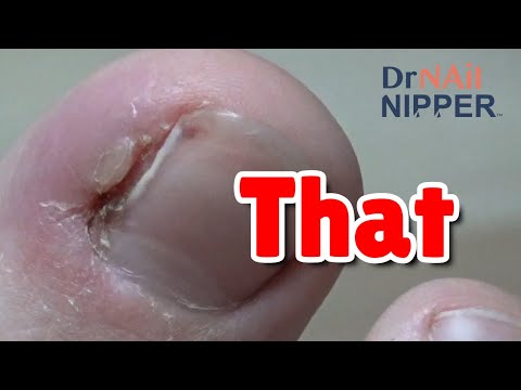 Callus Tuesday - Follow Ups (2021) 1