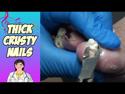 Fungal Crusty Nails - To Music! 1
