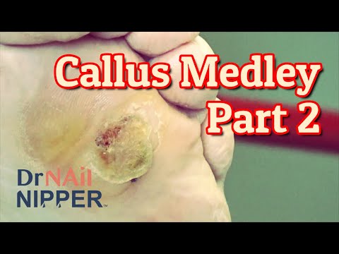 Callus Tuesday Medley Part 2 (2021) 1