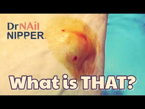 Cyst Pops on Foot ? Callus Tuesday (2021) 1