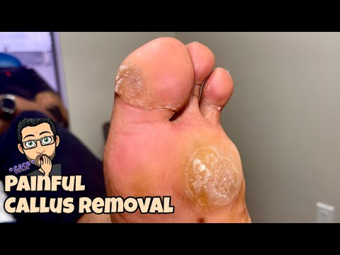 NEVER ENDING CALLUS REMOVAL FROM FEET 1