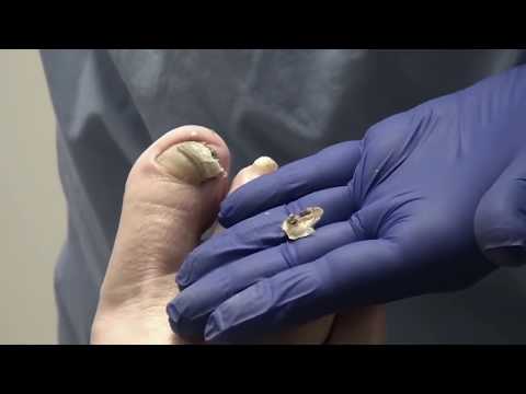 Thickest Ramshorn Nails by Dr. Nail Nipper 1 Thickest Ramshorn Nails by Dr. Nail Nipper 1