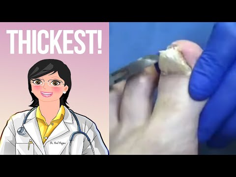 Really Thick Toenail - Gets the Works 1