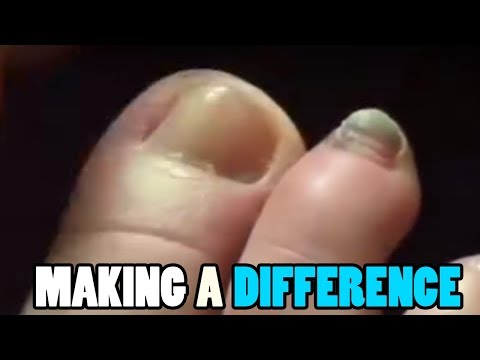 Dr. Nail Nipper's Making A Difference! Saving Lives 1