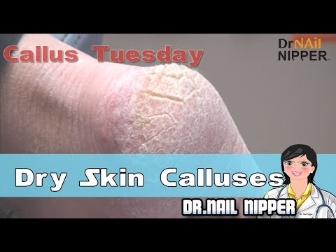 Dry Skin Calluses #2 - Callus Tuesday 1 Dry Skin Calluses #2 - Callus Tuesday 1