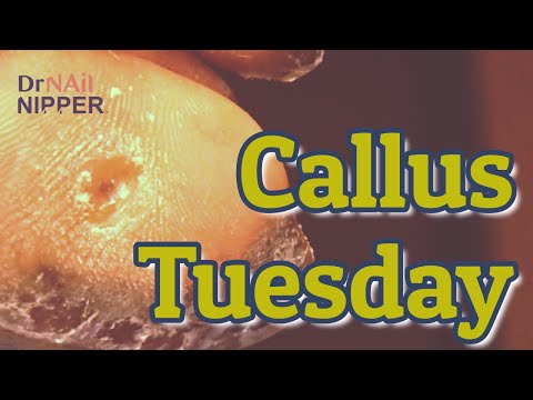 What does a Severe Callus look like? 👉 Dr Nail Nipper's Callus Tuesday 👈🏿 (2021) 1